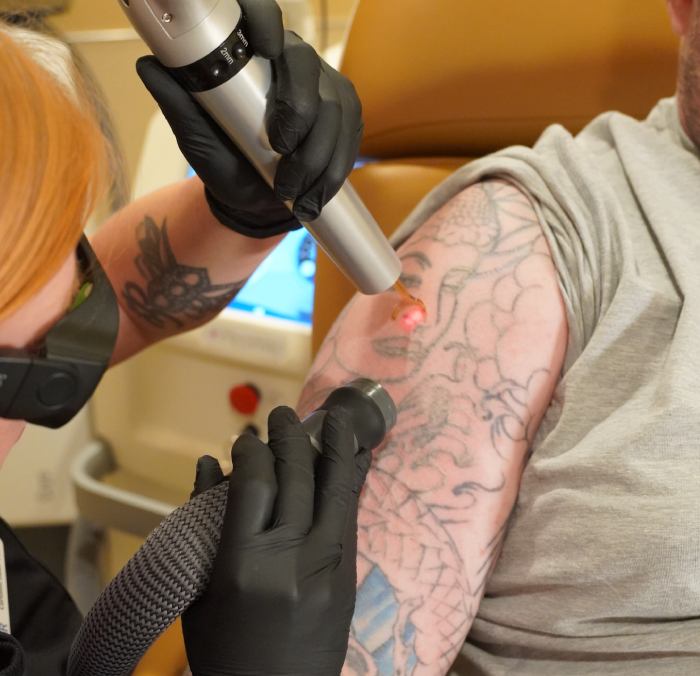 Laser Tattoo Removal: What Actually Determines How Fast a Tattoo Fades