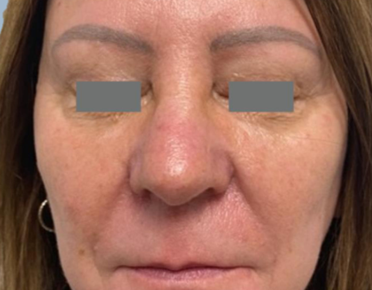 Before makeup removal treatment