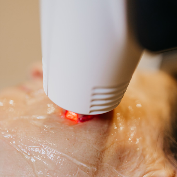 XERF vs. RF Microneedling & Sublative: What Actually Tightens Skin?