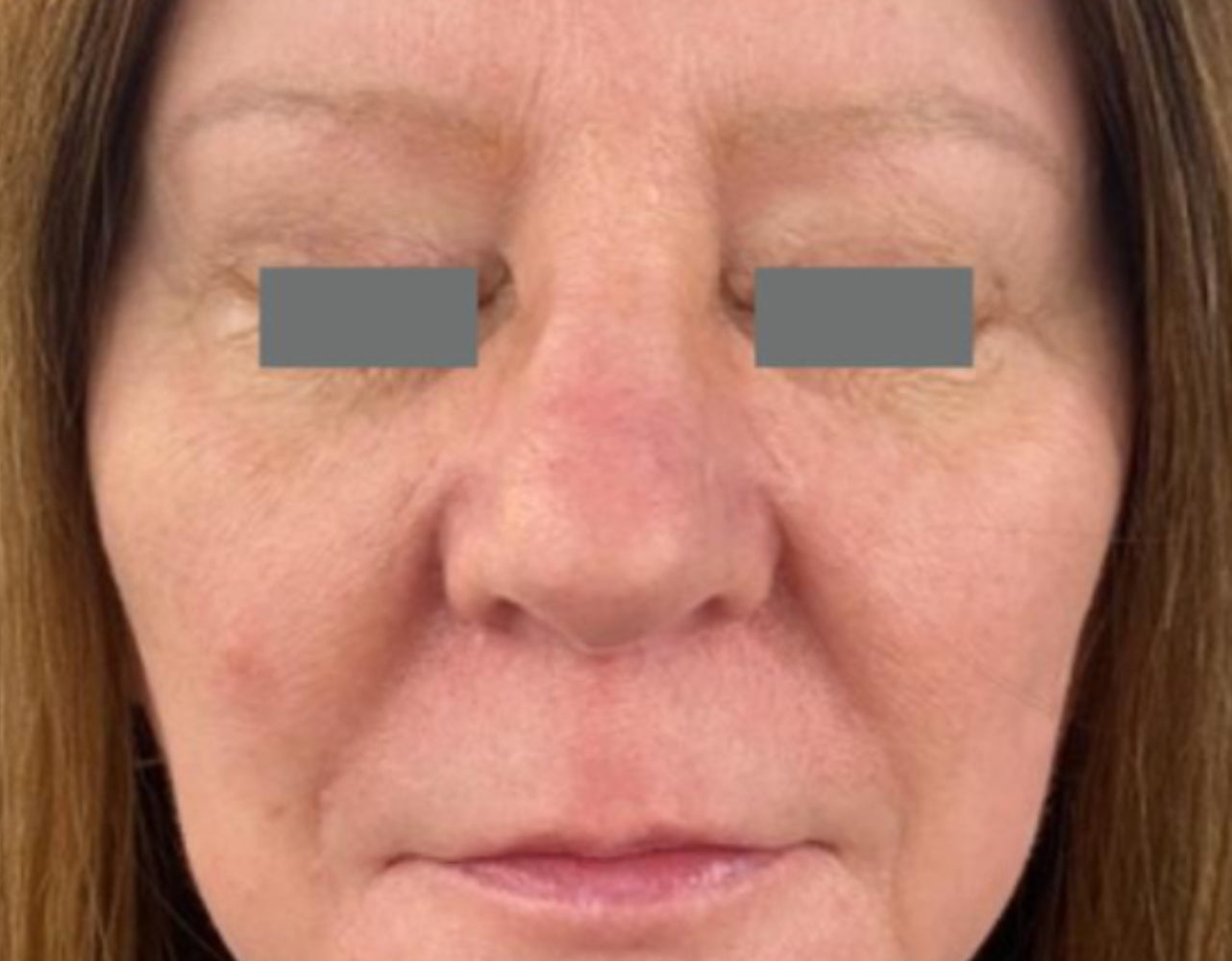 After makeup removal treatment