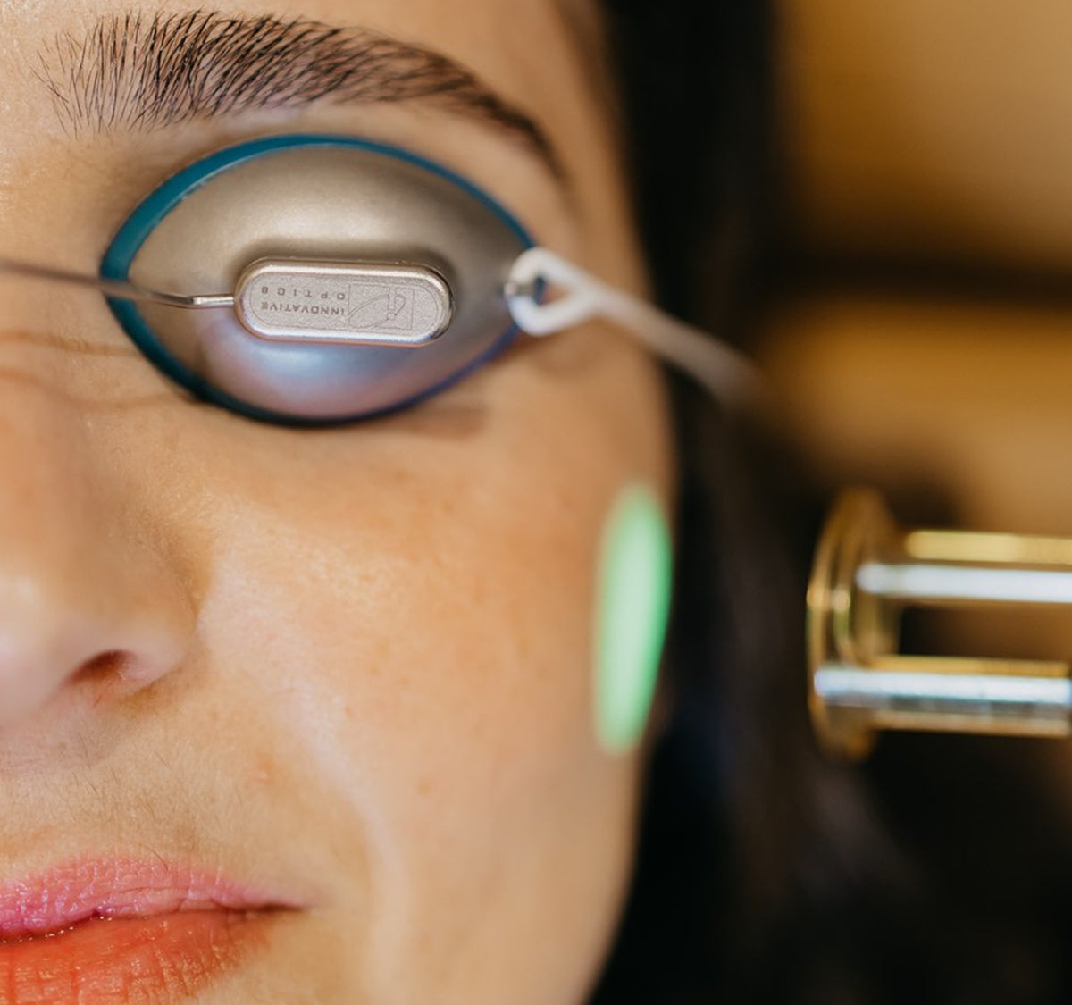 Person receiving laser facial treatment on cheek.