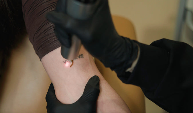 Tattoo removal being performed on forearm