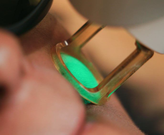 Close up of upper lip laser treatment